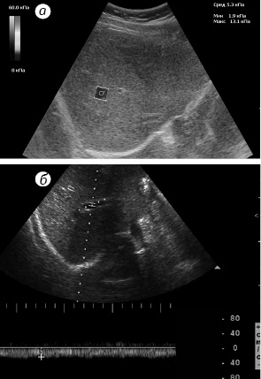 Рис. 1. Незмінена паренхіма печінки: а) картується синім кольором і має низькі показники жорсткості; б) Vmax у ворітній вені 34 см/с