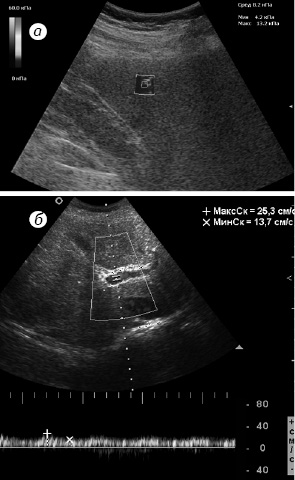 Рис. 2. Жировий гепатоз: а) жорсткість паренхіми становить 8,2 кПа; б) Vmax у ворітній вені 25 см/с