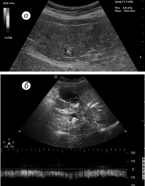 Рис. 4. При виражених змінах печінки а) середня жорсткість становить 13,2 кПа; б) Vmax у ворітній вені 15 см/с