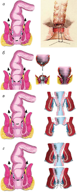 Рис. 1. Схематическое изображение уровня резекции ПК и методики реконструкции кишечника в группах исследования. а) Группа І — операция ПЭ: парциальная/субтотальная резекция внутреннего сфинктера ПК; ручной колоперианальный анастамоз на 10–15 мм дистальнее зубчатой линии; дивертивная стома не формировалась. б) Группа ІІ — НПР: степлерный колоректальный анастамоз; дивертивная илео­стома +(81%)/-(17%). в) Группа ІІІА — брюшно-анальная резекция (операция типа Турнбула): низведение ободочной кишки на промежность с избытком и формированием колоректального анастомоза в 2 этапа эвагинационным методом; дивертивная стома не формировалась. г) Группа ІІІВ — брюшно-анальная резекция (операция Нисневича — Петрова —Холдина): парциальная/субтотальная резекция внутреннего сфинктера ПК; низведение ободочной кишки с формированием колоэндоанального анастомоза в 2 этапа эвагинационным методом; дивертивная стома не формировалась