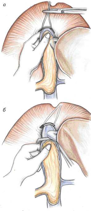 Рис. 1. Опухолевый тромб: а) фиксация опухолевого тромба пальцами; б) смещение верхушки тромба ниже устьев главных печеночных вен