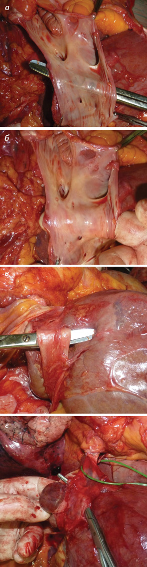 Рис. 4. Аутопсийное наблюдение успешного и безопасного формирования поперечного тоннеля под устьями главных печеночных вен