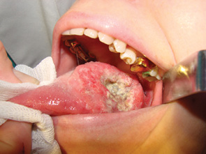 Рис. 2. Рак кореня язика