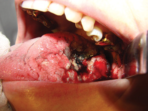 Рис. 3. Рак кореня язика. Перитуморально введено 2 мл 1% метиленового синього