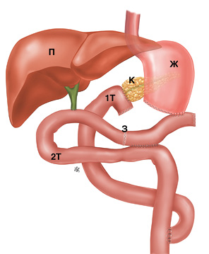 Рис. 5. Схема полностью изолированной реконструкции по Ру. К — культя поджелудочной железы; Ж — желудок; П — печень; 1Т — 1-я тонкокишечная петля; 2Т — 2-я тонкокишечная петля; 3 — заглушка на приводящую петлю