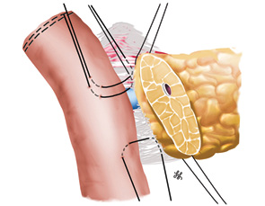 Рис. 6. Схема формирования зад­него ряда швов между серомускулярным слоем стенки кишки и соединительной тканью, расположенной между задней поверхностью поджелудочной железы и селезеночной веной