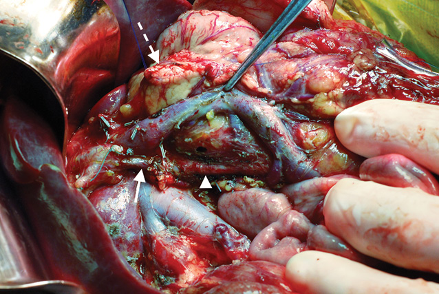 Рис. 14. Интраоперационный снимок после удаления гастропанкреатодуоденального комплекса (2-й клинический случай). Узкой стрелкой отмечена правая печеночная артерия, берущая начало от верхней брыжеечной артерии (широкая стрелка). Культя поджелудочной железы отмечена стрелкой с пунктиром