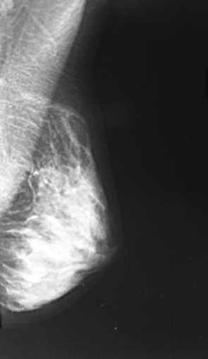 Рис. 1. Мамограма лівої грудної залози у медіолатеральній проекції