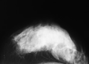 Рис. 2. Мамограма лівої грудної залози у краніокаудальній проекції