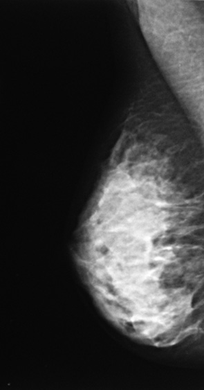 Рис. 3. Мамограма правої грудної залози у медіолатеральній проекції