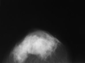 Рис. 4. Мамограма правої грудної залози у краніокаудальній проекції