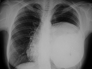 Рис. 5. Рентгенограма органів грудної порожнини у прямій проекції 