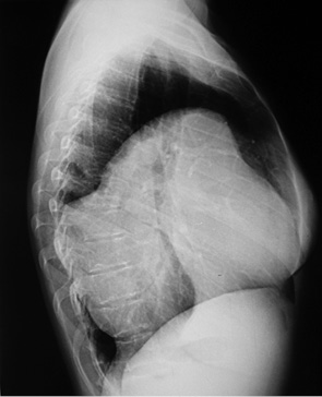 Рис. 6. Рентгенограма органів грудної порожнини у боковій проекції 