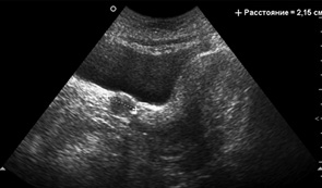 Рис. 1. Вдоль верхней трети влагалища определяется образование округлой формы, сниженной эхогенности с четкими контурами