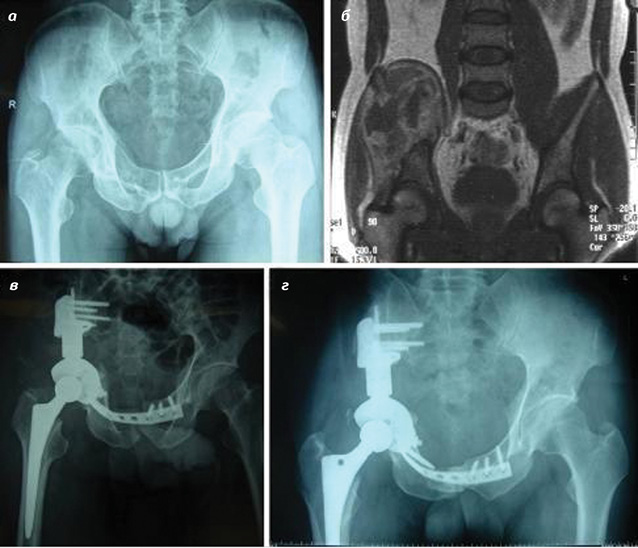 Рис. 3. Клінічний випадок успішно проведеного лікування у 63-річного чоловіка з хондросаркомою таза справа. Реконструкція модульним протезом для геміпельв­ектомії після I, II і ΙΙΙ типів резекції: a — рентгенограма показує літичне ураження навколо ацетабулярної западини; б — магнітно-резонансна томографія демонструє ураження пухлиною ацетабулярної западини з великим м’якотканинним компонентом; в — післяопераційна рентгенограма показує органозбережну реконструкцію лівого тазового кільця, досягнуту за допомогою імплантації модульного протеза для геміпельв­ектомії; г — 12 міс після реконструкції [42]