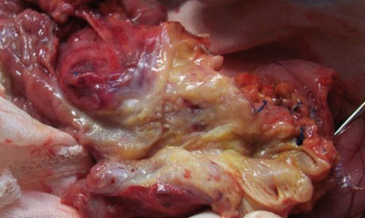 4 Гигантоклеточная опухоль поджелудочной железы (наблюдение из практики)