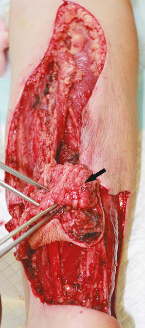 Рис. 2. Підшкірна жирова клітковина передпліччя скручена у вигляді «ролу» для збільшення об’єму тканин клаптя (показано стрілкою)