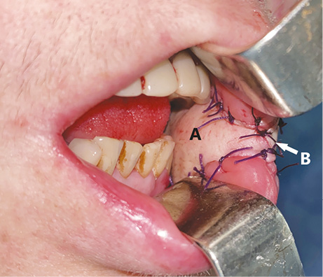 Рис. 9. Заміщений дефект слизової оболонки щоки (А), сформована комісура рота (В)